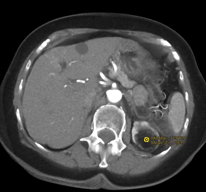 Left Renal Angiomyolipoma-AML - CTisus CT Scan