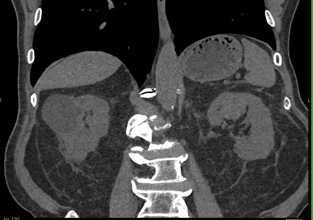 Left Papillary Renal Cell Carcinoma - CTisus CT Scan