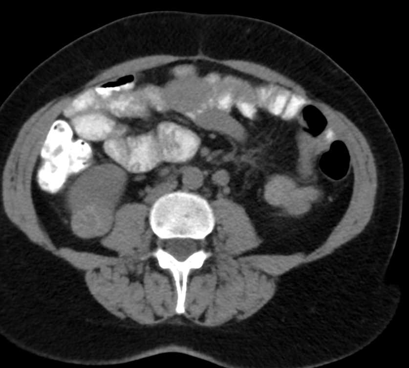 Papillary Renal Cell Carcinoma - CTisus CT Scan