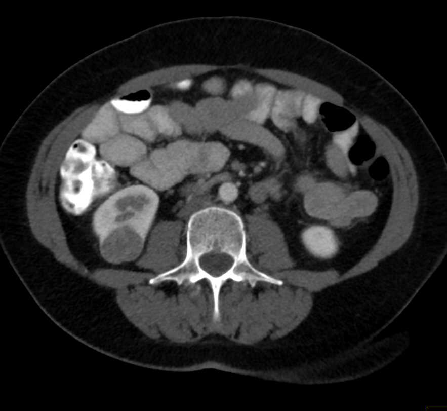 Papillary Renal Cell Carcinoma - CTisus CT Scan