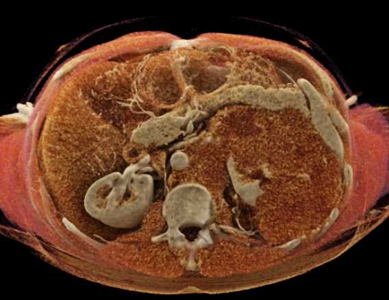 Lymphoma Infiltrates the Left Kidney - CTisus CT Scan