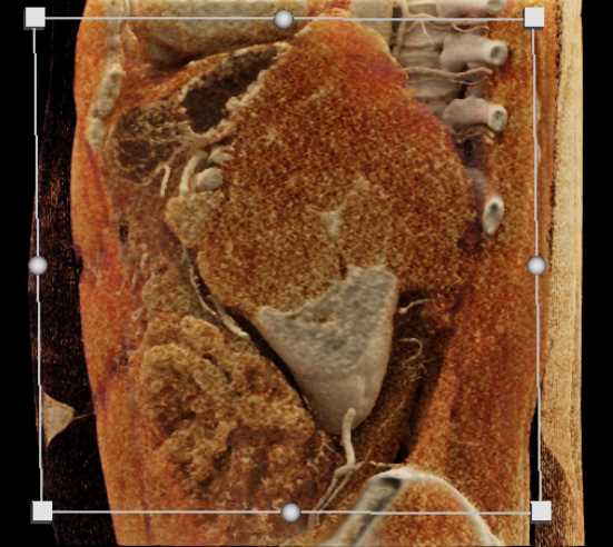 Lymphoma Infiltrates the Left Kidney - CTisus CT Scan