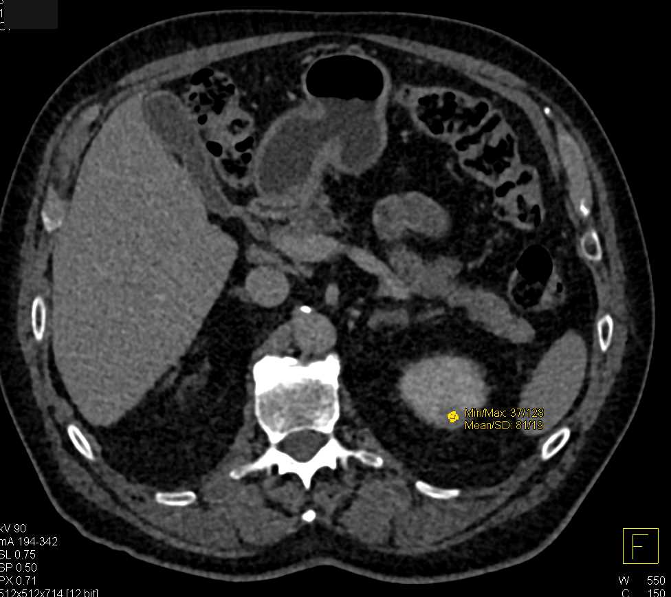 High Density left Renal Cyst - CTisus CT Scan