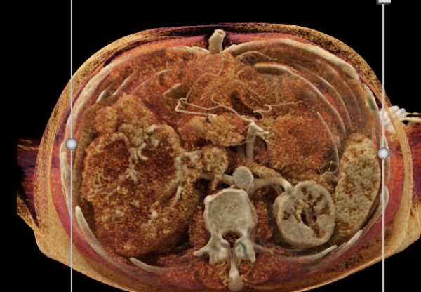 Left Renal Cell Carcinoma Invades the Inferior Vena Cava (IVC) - CTisus CT Scan