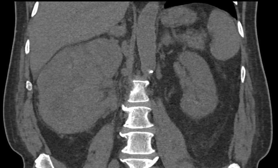 Left Renal Cell Carcinoma Invades the Inferior Vena Cava (IVC) - CTisus CT Scan