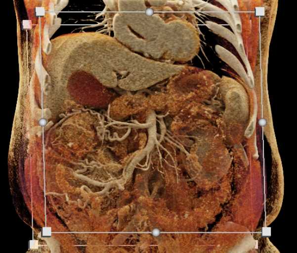 Left Renal Cell Carcinoma Invades the Inferior Vena Cava (IVC) - CTisus CT Scan