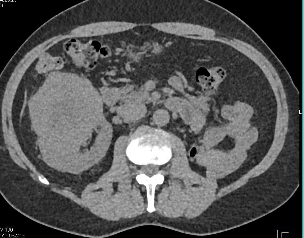 Clear Cell Renal Cell Carcinoma (ccRCC) - CTisus CT Scan
