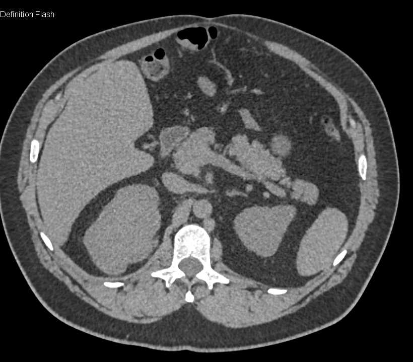 Papillary Renal Cell Carcinoma - CTisus CT Scan