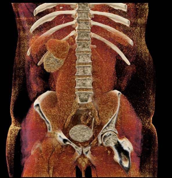 Papillary Renal Cell Carcinoma - CTisus CT Scan