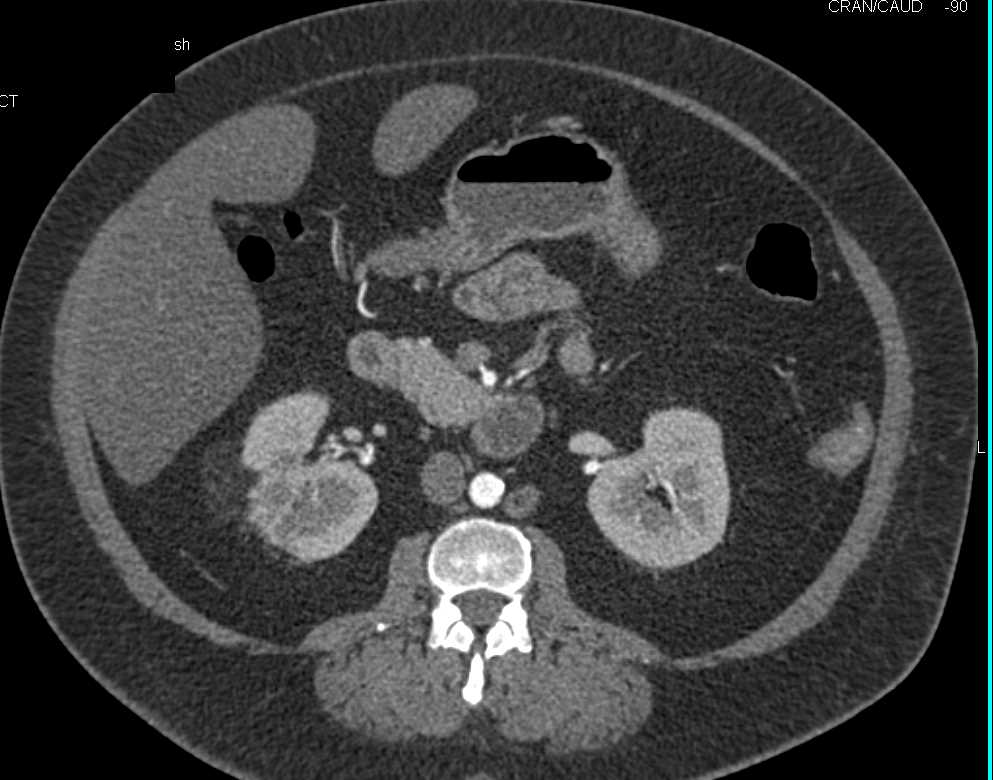 Angiomyolipoma Right Kidney - CTisus CT Scan