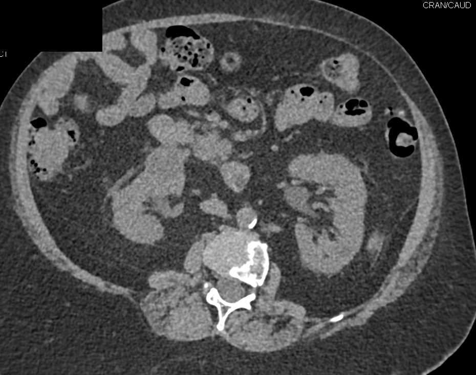 Cystic Renal Cell Carcinoma - CTisus CT Scan