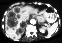 Liver Metastases From Colon Cancer - CTisus CT Scan