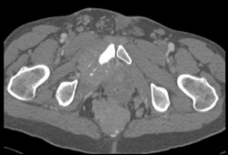 Carcinoid Tumor - CTisus CT Scan