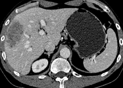 Metastatic Colon Cancer to Liver - CTisus CT Scan