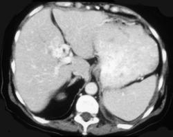 Cavernous Transformation of the Portal Vein - CTisus CT Scan