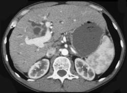 Caroli's Disease - CTisus CT Scan