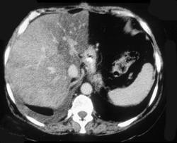 Focal Fatty Infiltration of the Liver Secondary to Radiation Therapy - CTisus CT Scan