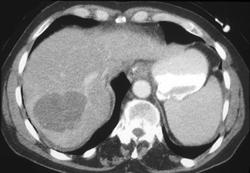 Liver Abscess - CTisus CT Scan