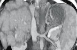 Cirrhosis of the Liver With Varices (coronary Vein) - CTisus CT Scan