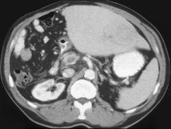 Portal Vein Thrombosis in A Patient With A Recurrent Hepatoma - CTisus CT Scan