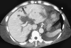 Hepatic Infarcts S/P Liver Transplant - CTisus CT Scan