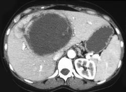 Hepatic Adenoma That Recently Bled - CTisus CT Scan