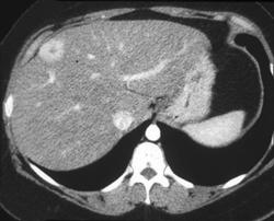 Multiple Focal Nodular Hyperplasia - CTisus CT Scan