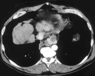 Cirrhosis With Esophageal Varices - CTisus CT Scan