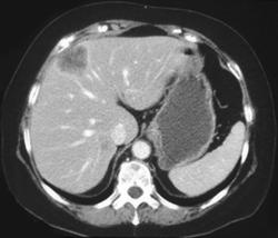 Liver Metastases Due to Colon Cancer - CTisus CT Scan
