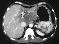 Radiation Changes in the Liver (fatty Infiltration) - CTisus CT Scan