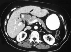 Cholangiocarcinoma of the Common Duct - CTisus CT Scan