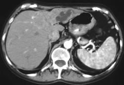 Dual Phase CT of Cholangiocarcinoma of the Left Lobe of the Liver.  the Lesion Is Seen Best on the Portal Phase Images. - CTisus CT Scan
