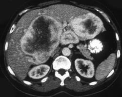 Hemangioendothelioma of the Liver - CTisus CT Scan