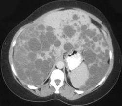 Polycystic Liver Disease - CTisus CT Scan