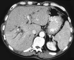 Thad Defect Due to Dilated Biliary Ducts - CTisus CT Scan