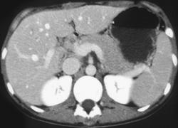 Dual Phase Liver With Hepatic Pseudolesions - CTisus CT Scan