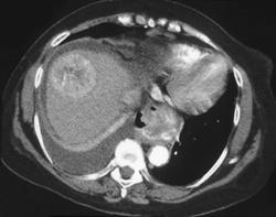 Hepatoma - CTisus CT Scan