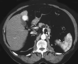 Metastatic Renal Cell Carcinoma to the Liver - CTisus CT Scan