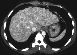 Nodular Cirrhosis on Dual Phase Study (simulates Metastases) - CTisus CT Scan