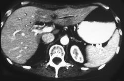 Radiation Changes to Left Lobe of Liver - CTisus CT Scan