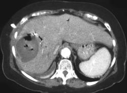 Hepatic Abscess - CTisus CT Scan