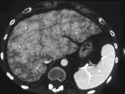 Cirrhosis - CTisus CT Scan