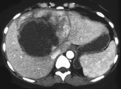 Hepatic Adenoma With Prior Bleed - CTisus CT Scan