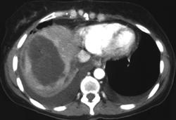 Normal Changes in Liver Following Cryosurgery - CTisus CT Scan