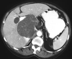 Biliary Cystadenoma - CTisus CT Scan