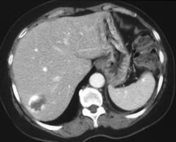 Hemangioma - CTisus CT Scan