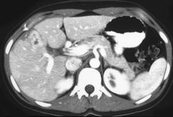 Focal Nodular Hyperplasia (FNH) - CTisus CT Scan