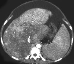 Budd-Chiari Syndrome - CTisus CT Scan