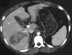 Liver Laceration With Right Adrenal Hemmorrhage - CTisus CT Scan