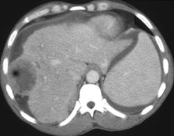 Hepatoma - CTisus CT Scan